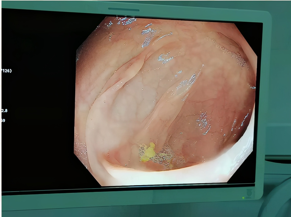 鹿城结直肠癌免费筛查,惠民胃肠癌筛查活动