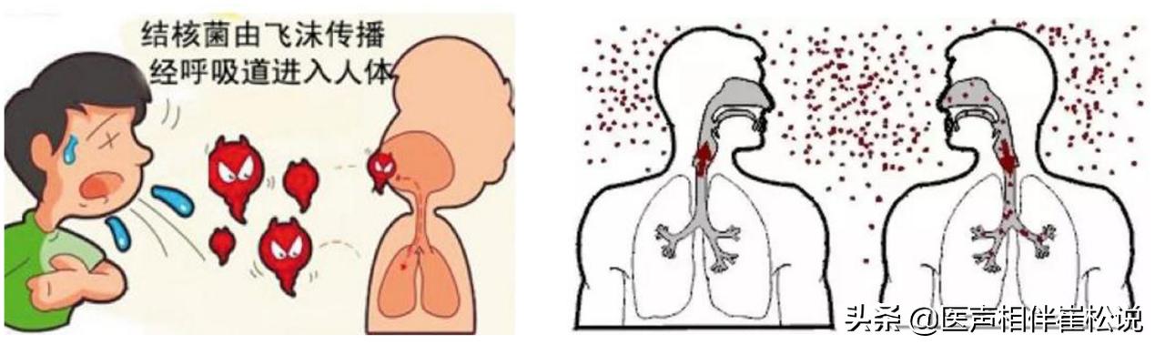 死灰复燃的病例,潜在结核病