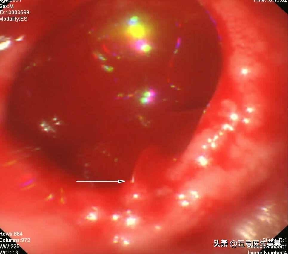切息肉需要停阿司匹林吗,服用阿司匹林不能手术吗