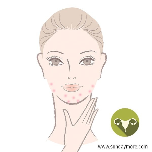 暗疮最好的消除方法 (暗疮印最佳治疗方法)