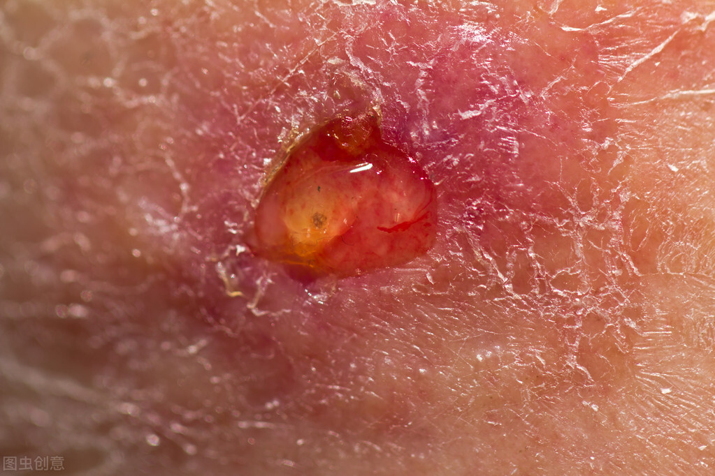 85岁老人胳膊上长小肉粒溃烂,老人手臂肉肿块贴啥药膏