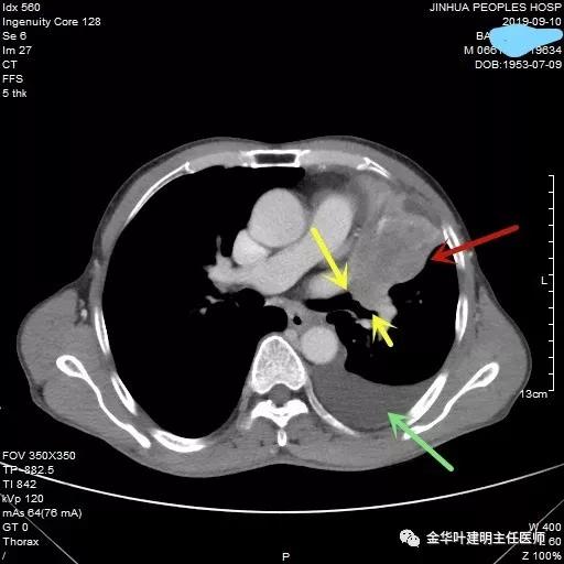 肺癌伴胸腔积液伴膨胀不全,肺癌晚期转移到肝脏引起腹腔积液