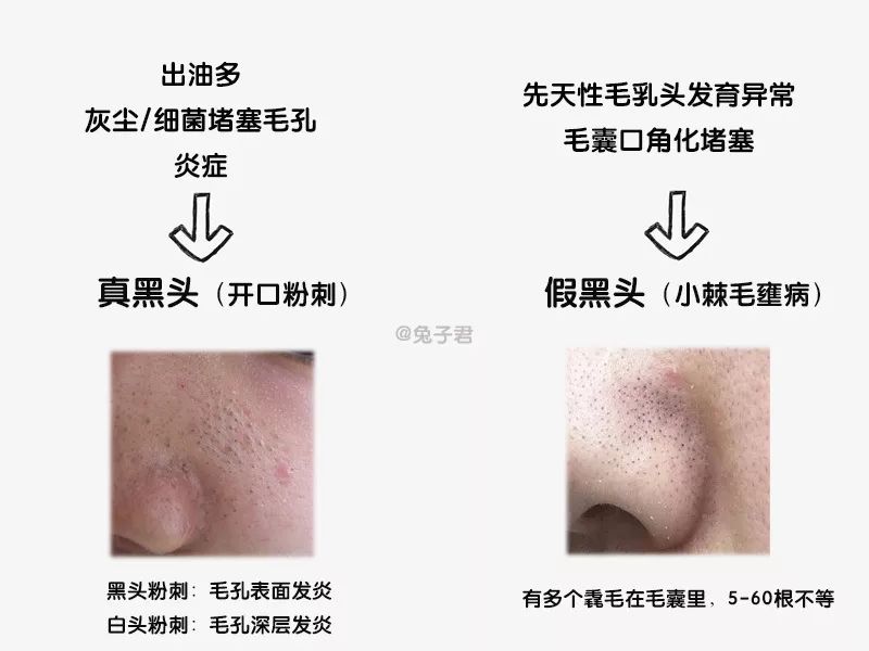 男生如何瘦腿,男生去黑头最好的面膜