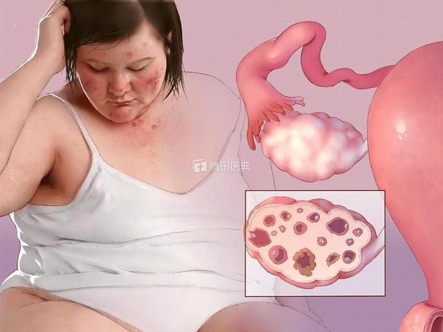 多囊卵巢吃复方玄驹胶囊的作用,复方玄驹胶囊可以治疗少精弱精吗