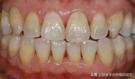 改变刷牙方式楔状缺损就会停止吗,刷牙导致楔状缺损牙齿会断么