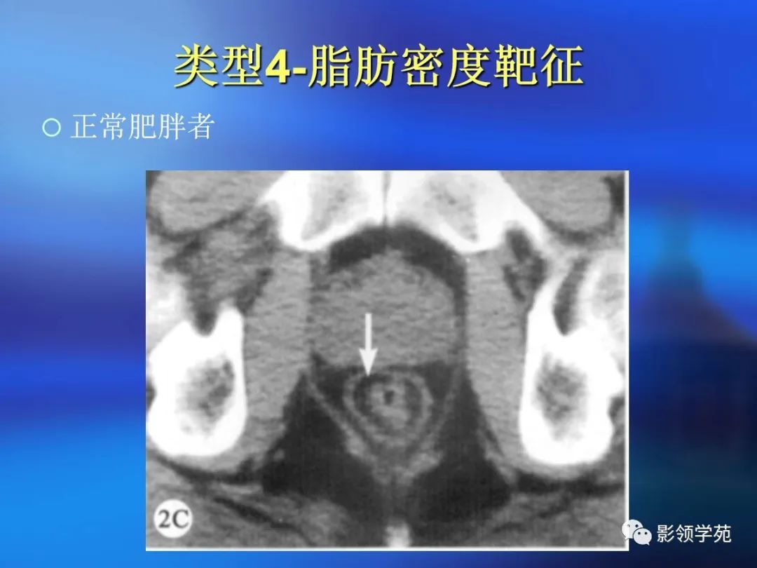 肠道内壁增厚,肠道扩张ct表现