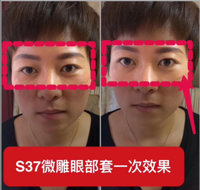 s37微雕眼霜代理,s37微雕眼霜去眼袋