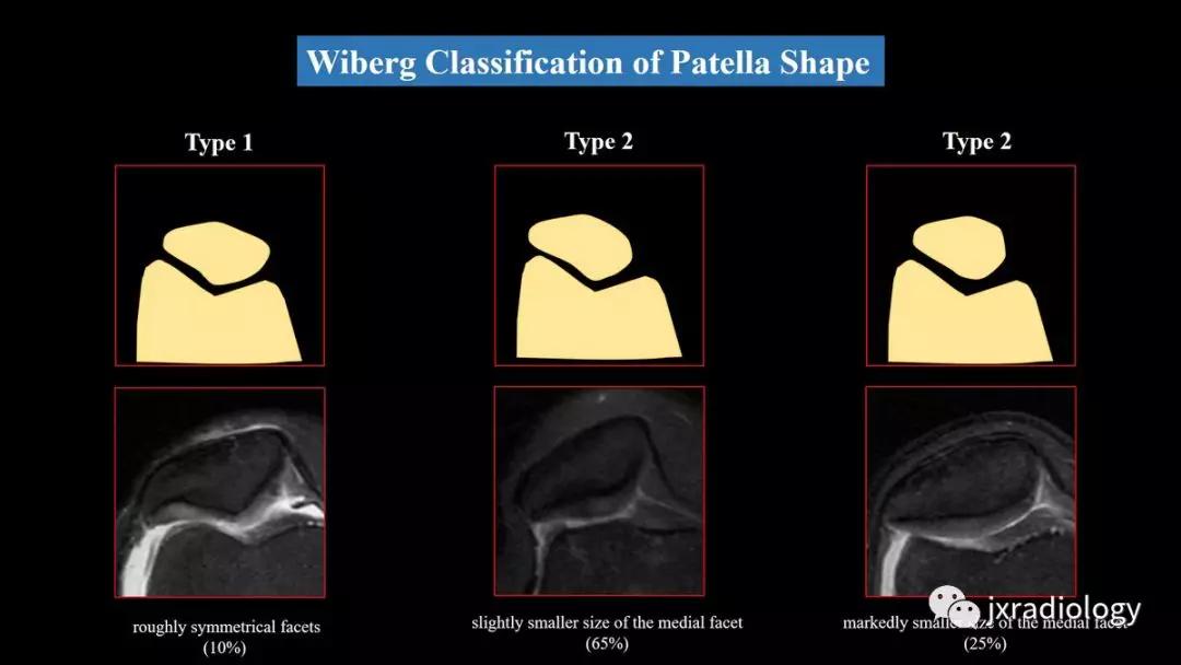 髌股关节失常磁共振看什么,髌股关节混乱的影像评估