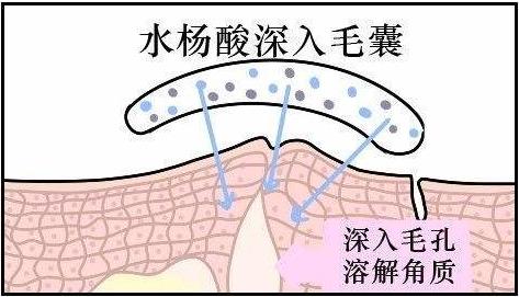 战痘用药,战痘必须懂的知识
