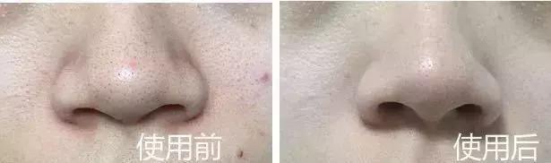 洗脸清洗黑头,洗脸清洁去粉刺