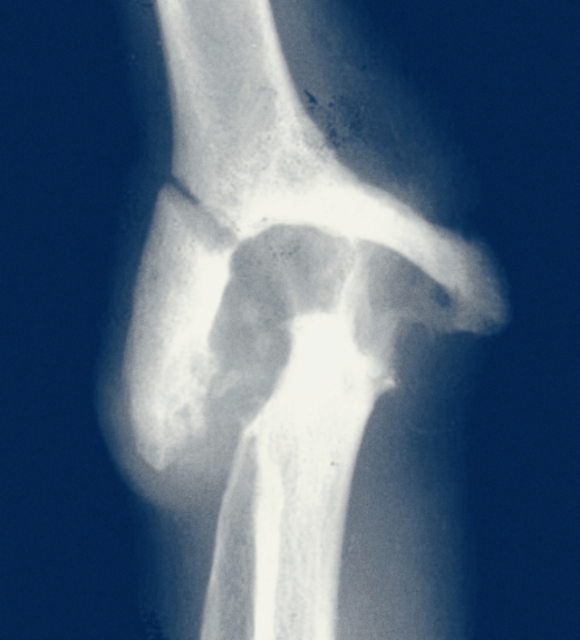 “医生,我胳膊肘伸不直了,还用不了筷子了,我是怎么了啊?”