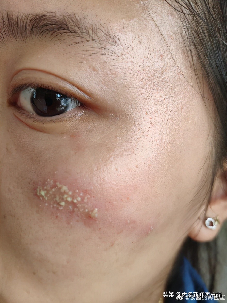 隐翅虫上热搜,一条小虫子上热搜