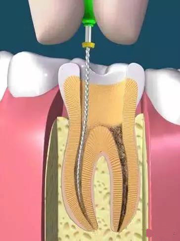 牙齿上出现了黑线怎么办,牙齿上都有黑线怎么办