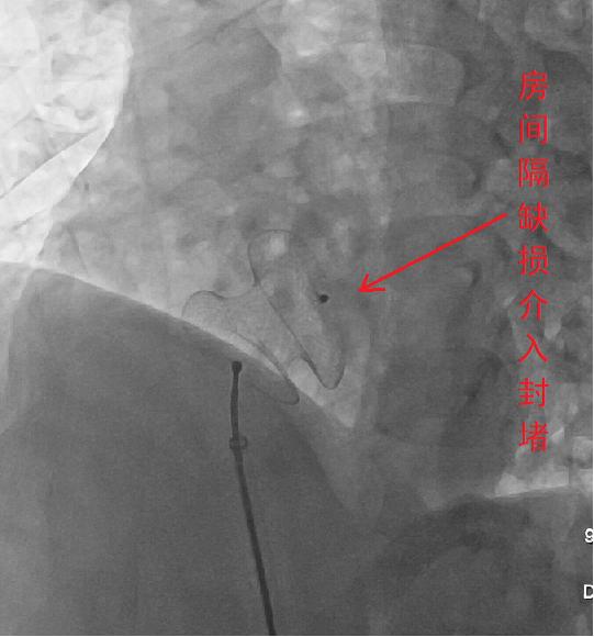 心肌缺血心肌梗死怎么检查,心肌梗死怎么样急救