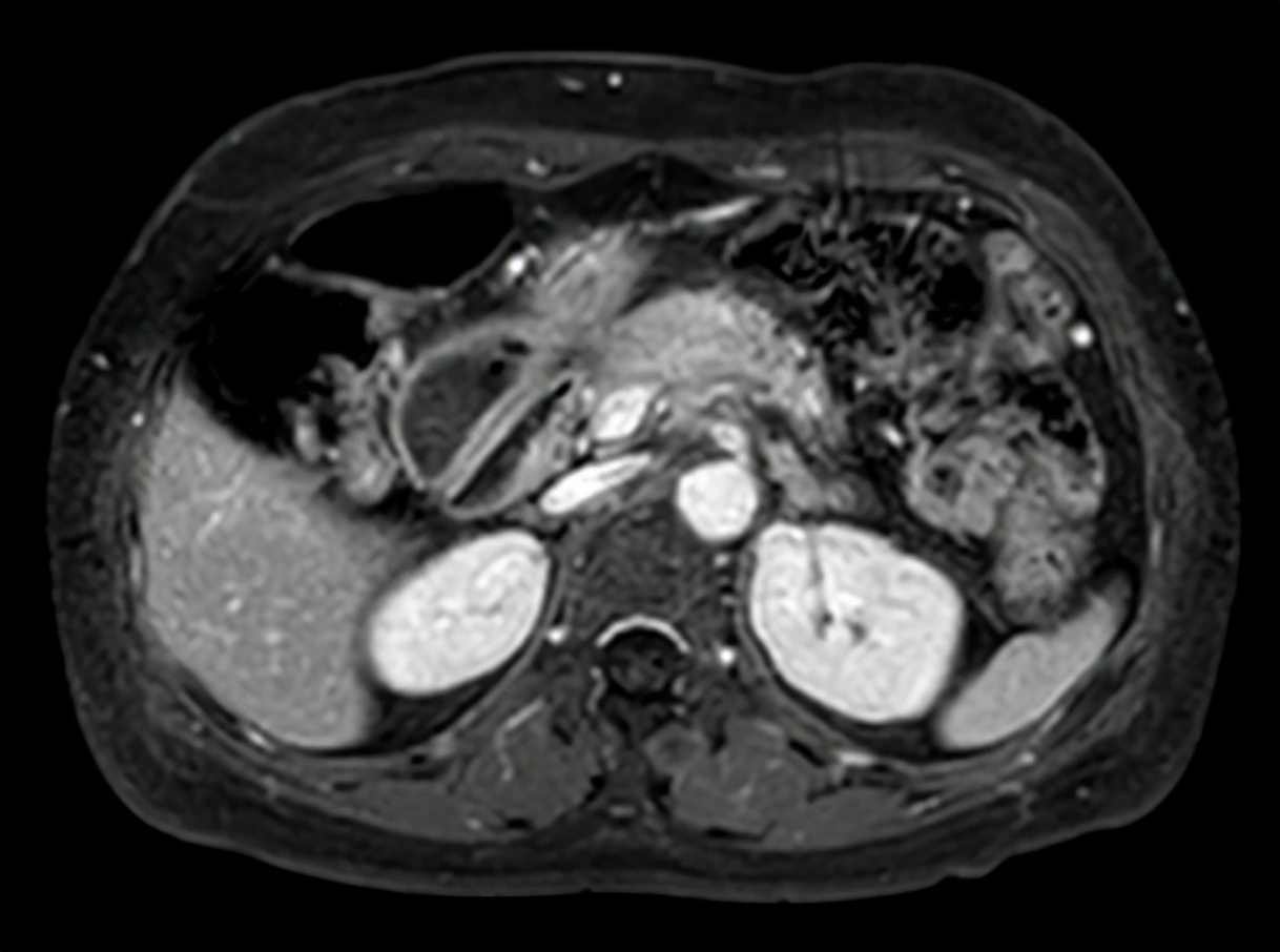 胰腺癌胃痛是什么情况,胃痛和胰腺炎区别与图片