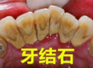 牙结石要怎么处理,自己在家处理牙结石