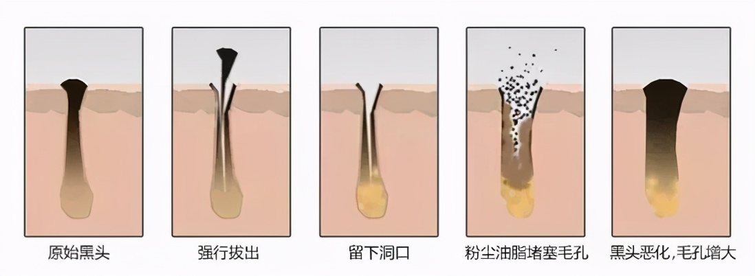 黑头成因及对策全攻略,黑头的形成原因你知道吗