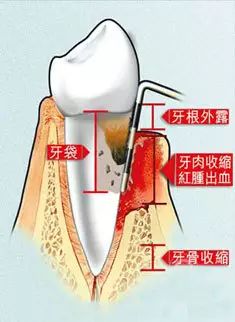 牙齿变长了黄的部分是牙根吗,牙齿长得细长有什么说法吗