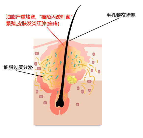 暗疮泛红用碘伏能消炎吗,起脓疮型痘痘用什么药