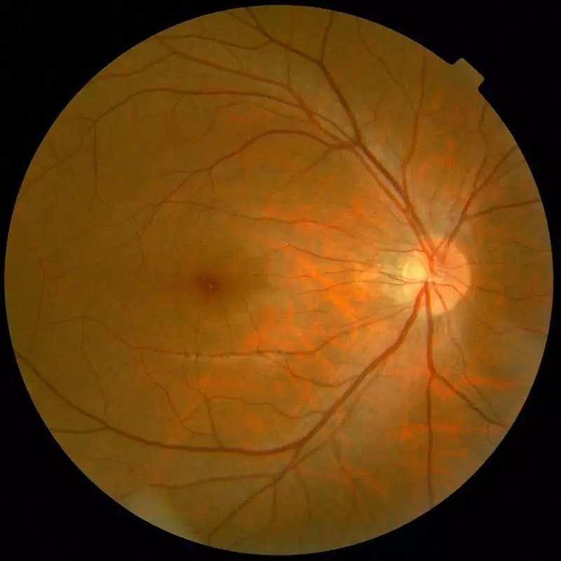 中山眼科中心眼底病专科诊治,大连老年病医院眼科电话号码