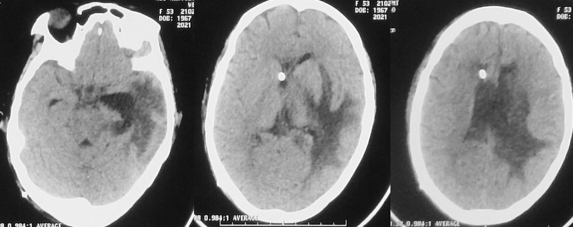 脑脓肿合并脑膜炎需要手术吗,脑脓肿进入左侧脑室严重吗
