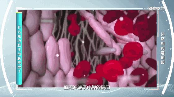 血管主动脉夹层能活多久,警惕凶险的主动脉夹层你了解多少