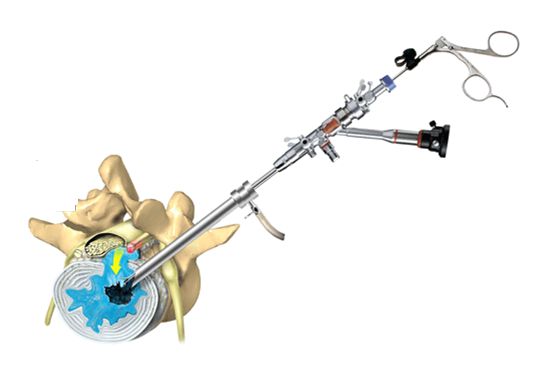 腰椎间盘突出到底能不能看好,腰椎间盘突出能正骨回去吗