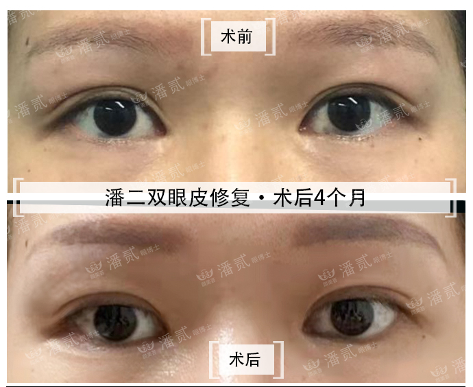 双眼皮失败的女孩,双眼皮失败做成了三眼皮好修复吗