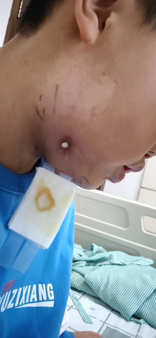 牙源性上颌窦炎牙龈瘘管,牙源性脓肿的症状