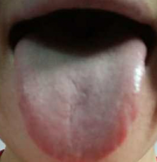 脸和脖子烧灼感,脸过敏烧灼感怎么回事