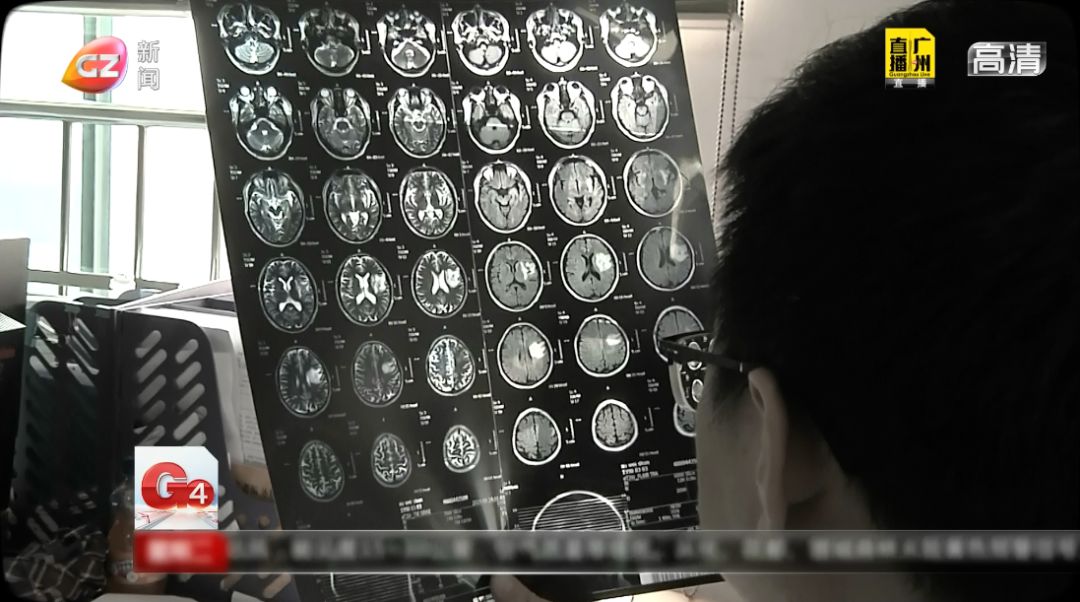 偏方不可信吞鱼胆清火致垂危,吃蛇胆取出30公分寄生虫