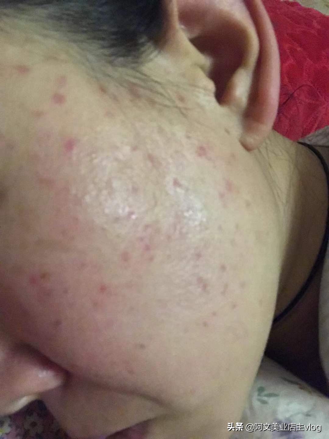 阿文讲她的青春痘扁平疣历史，分享护肤小知识
