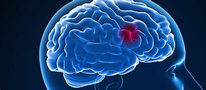 高血压的人怎样预防中风,高血压预防中风首选哪种药