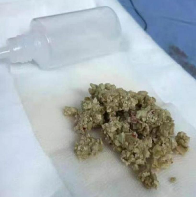 腰痛要警惕四种肾结石原因,腰痛结石痛得剧烈怎么办