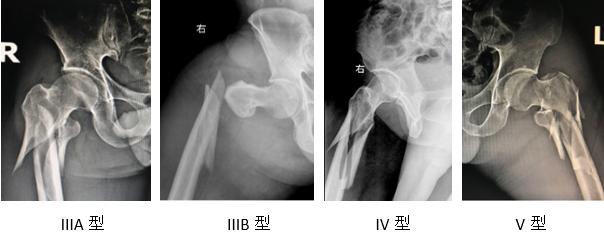 髋部骨折危害大老年人摔伤要重视,髋部骨折的最简单方法