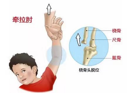 小孩子经常脱臼什么原因,小朋友容易脱臼是什么原因