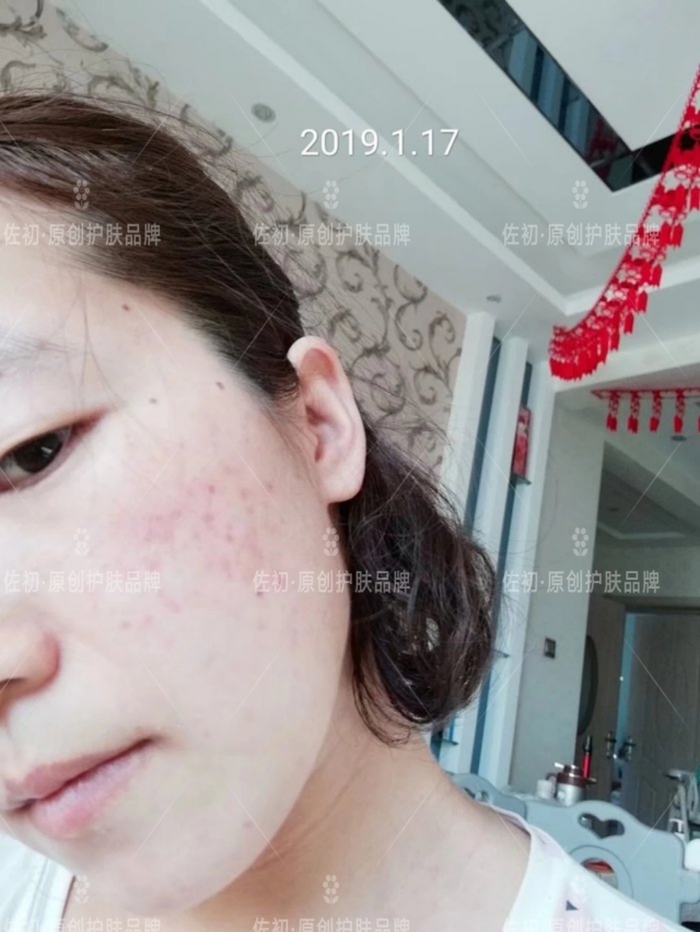 生完孩子烂脸,生完孩子脸上垮了怎样处理