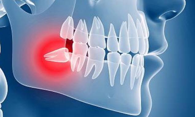 牙医建议拔牙就一定要拔吗,牙医总劝你拔牙