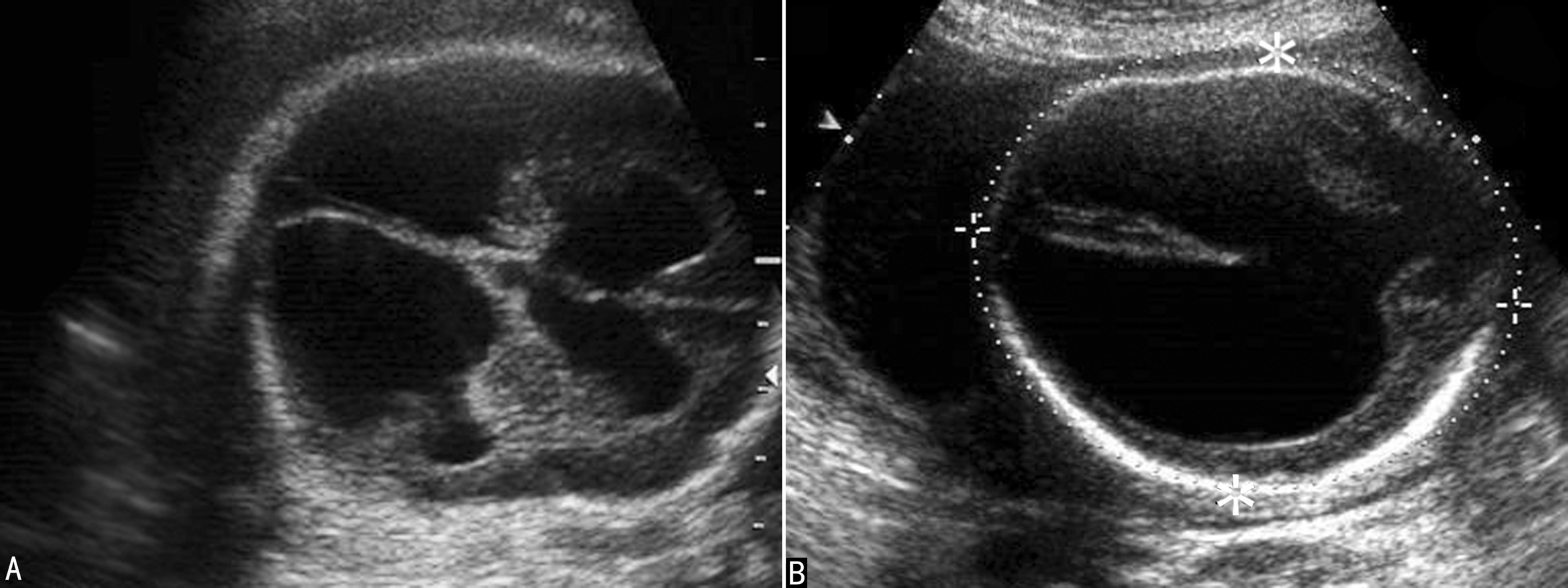 胎儿脑积水的超声图像,胎儿脑积水25m超声图