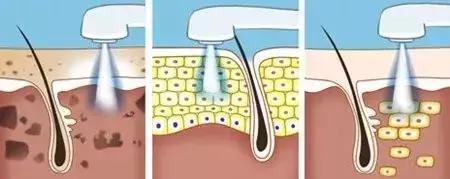 做光子嫩肤前需要清闭口么,强脉冲光和光子嫩肤区别