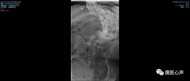 腰弯成s型怎么办,腰弯了会怎么样