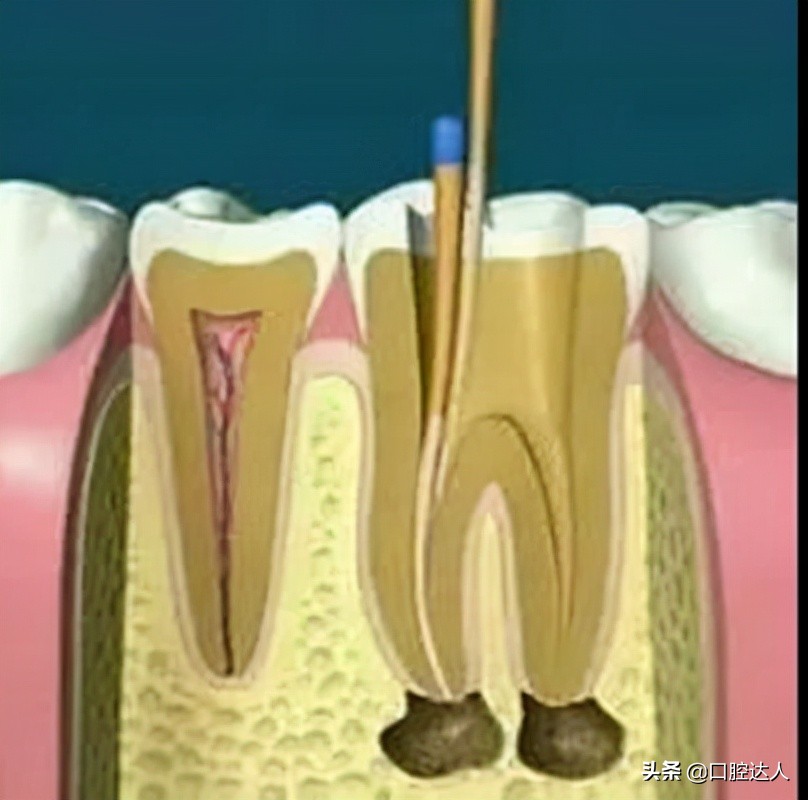 智齿牙疼半夜睡不着怎样能缓解,小孩牙疼睡不着觉怎么缓解