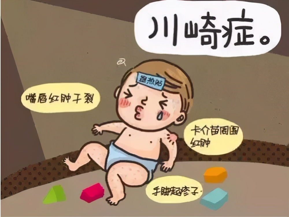 川崎病儿童临床表现,儿童川崎病复发指标