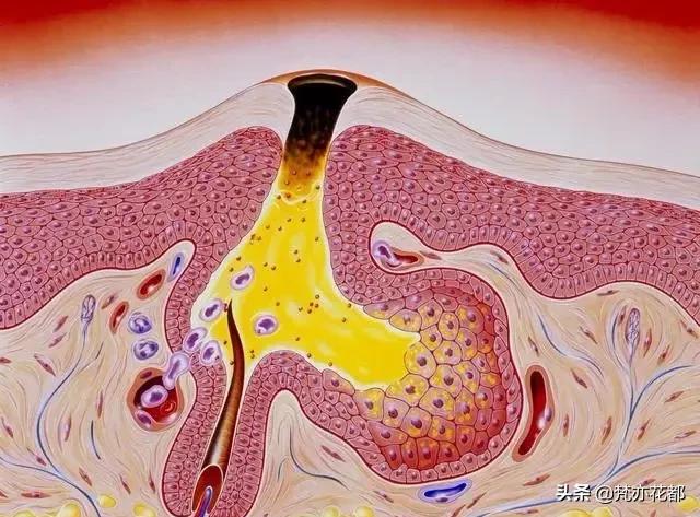 如何去黑头最有效方法,去黑头收缩毛孔最有效的方法