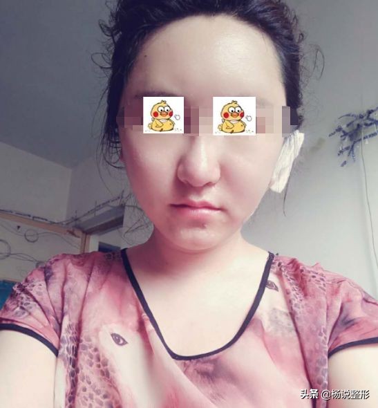 20岁面部凹陷如何改善,脂肪填充面部凹陷怎么导致的呢