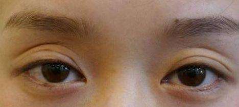 凹眼皮适合做双眼皮吗,眼窝凹陷眼睛突双眼皮不明显