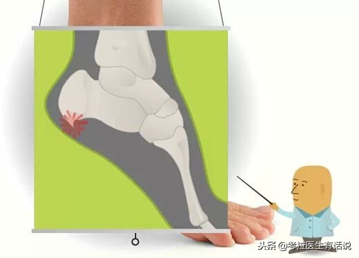 足跟骨刺疼痛一招解决是真的吗,骨刺导致足跟痛需要注意什么