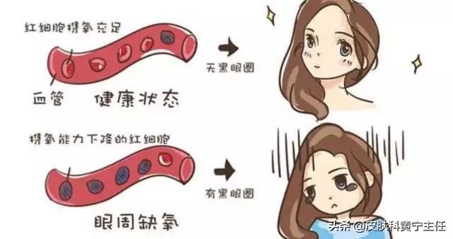 黑眼圈用中医治疗法,黑眼圈的分型和对症治疗