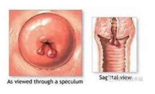 宫颈息肉不切除有什么危害,宫颈息肉消融术的危害