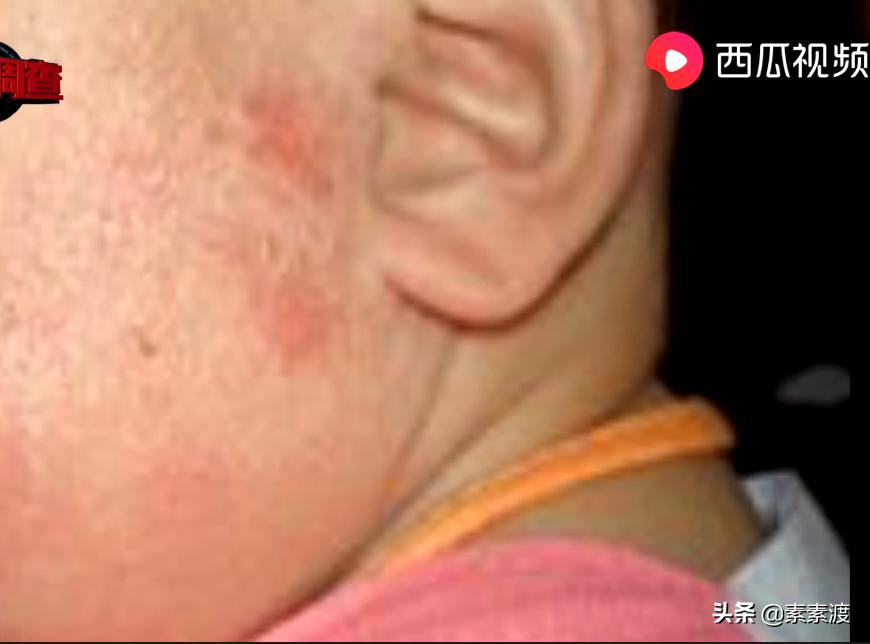 小儿喝假奶粉成大头娃娃,假奶粉吃成大头娃娃